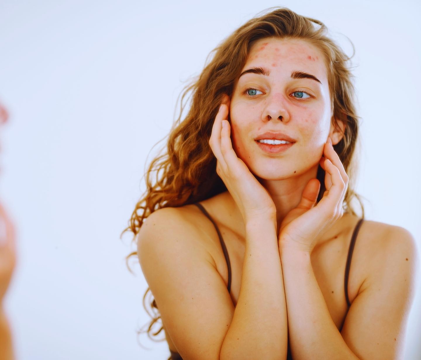 Resultados no tratamento da acne